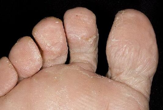 Manifestations of a fungal infection on the feet