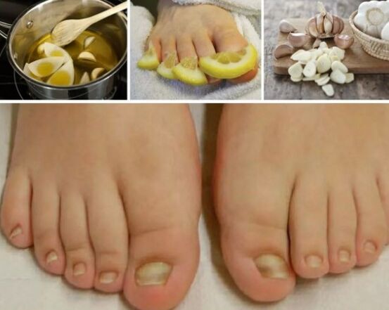 Folk remedies for nail mushrooms