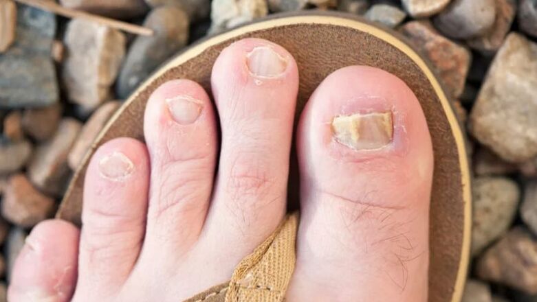 Nail yeast