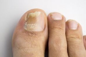 Disease with a fungus