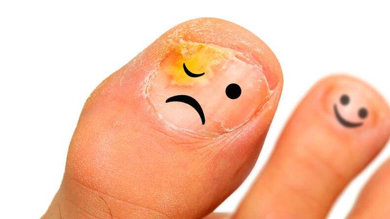 Nail mushroom
