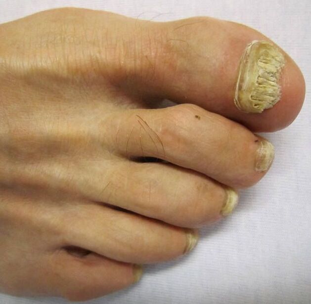 Damage nail plates