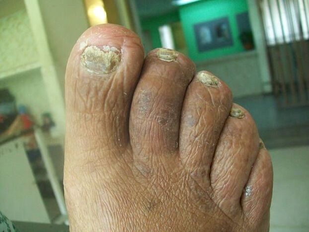 The mushroom lesion