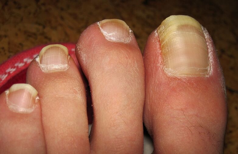 yellowing of nails with fungus