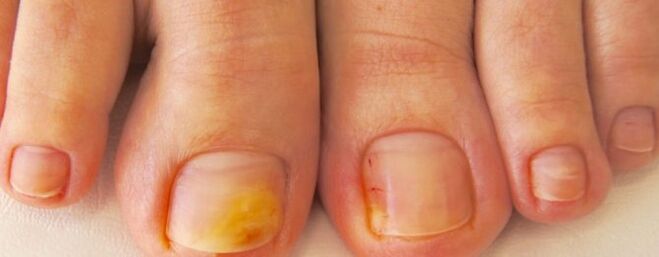 Nail mushroom