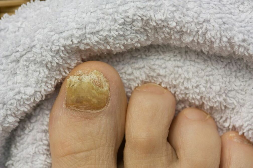 Atrophic stage of the fungus (falling off pieces of nail)