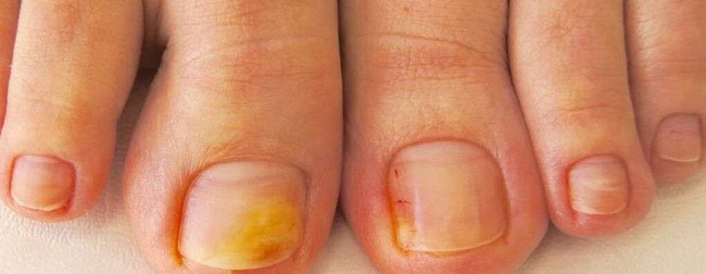 The initial stage of onychomycosis - yellowing of the nails