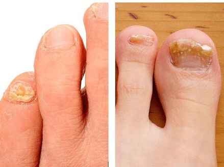 Nail mushroom