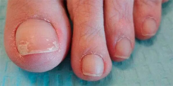 Fungal legs stages