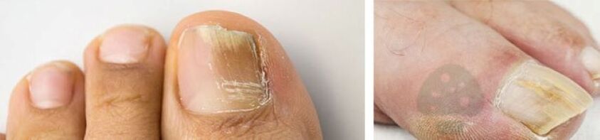 The fungus of thumbs up on the leg