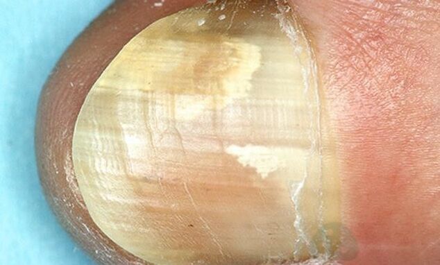Treatment of fingertips with their fingertips with internal action drugs