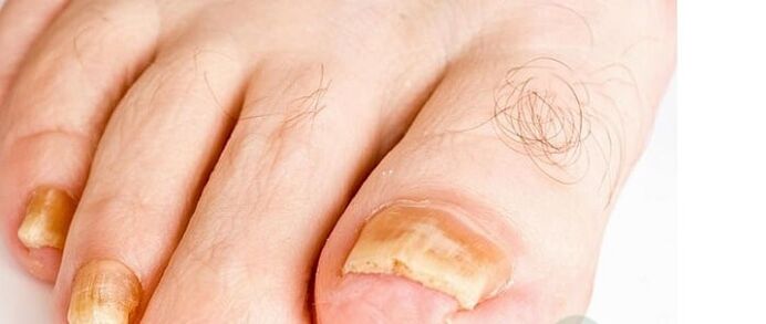 Varieties of the finger nail fungus