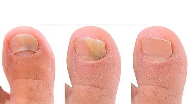 stages of development of nail fungus