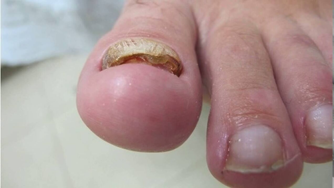 Hypertrophic fungus - deformation of the edges, loss of color and thickening of the nail plate