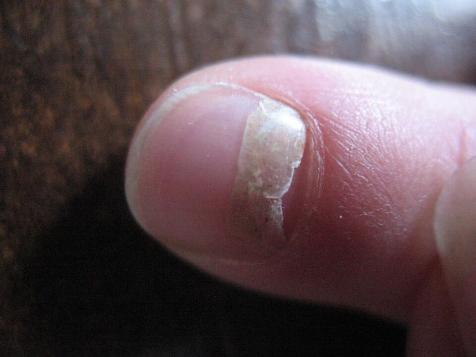 The onycholytic type of fungus is accompanied by detachment of the nail plate