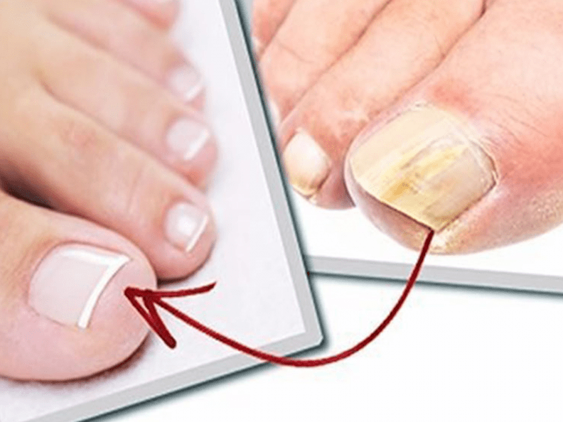 Nails affected by fungus and healthy nails after home treatment